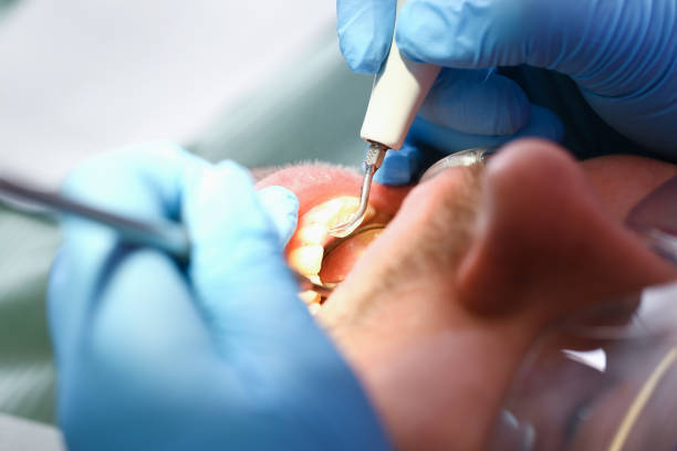 Best Emergency Root Canal Treatment in Richmond Hill, GA